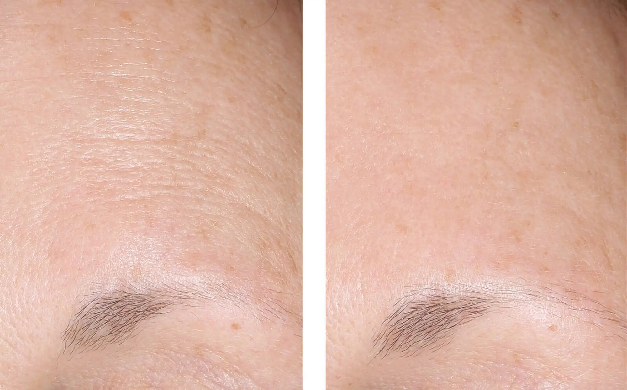 Before and after photos of a skincare protocol, Atelier Med selection.