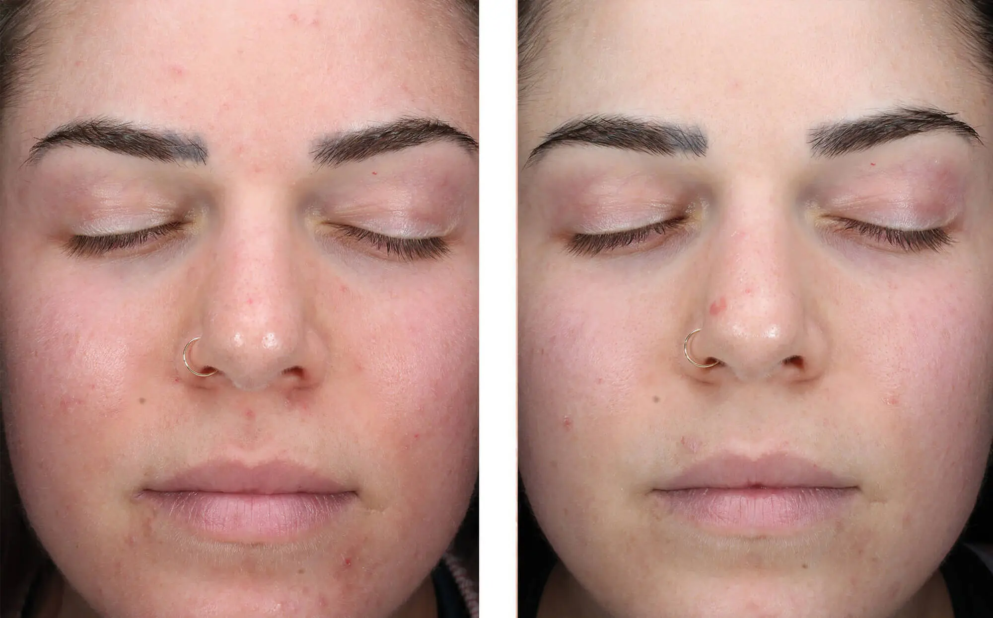 Before and after photos of a skincare protocol, Atelier Med selection.
