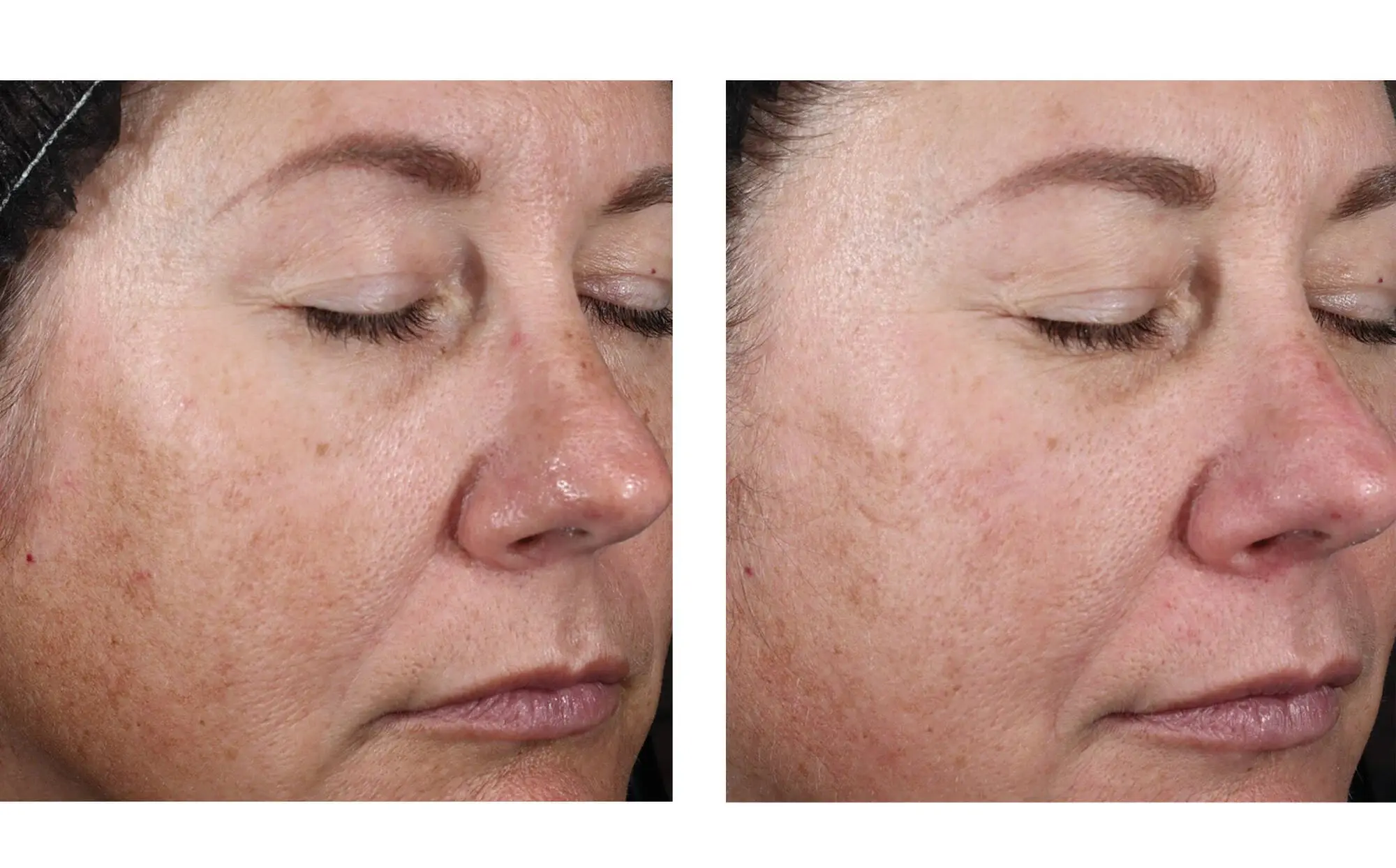 Before and after photos of a skincare protocol, Atelier Med selection.