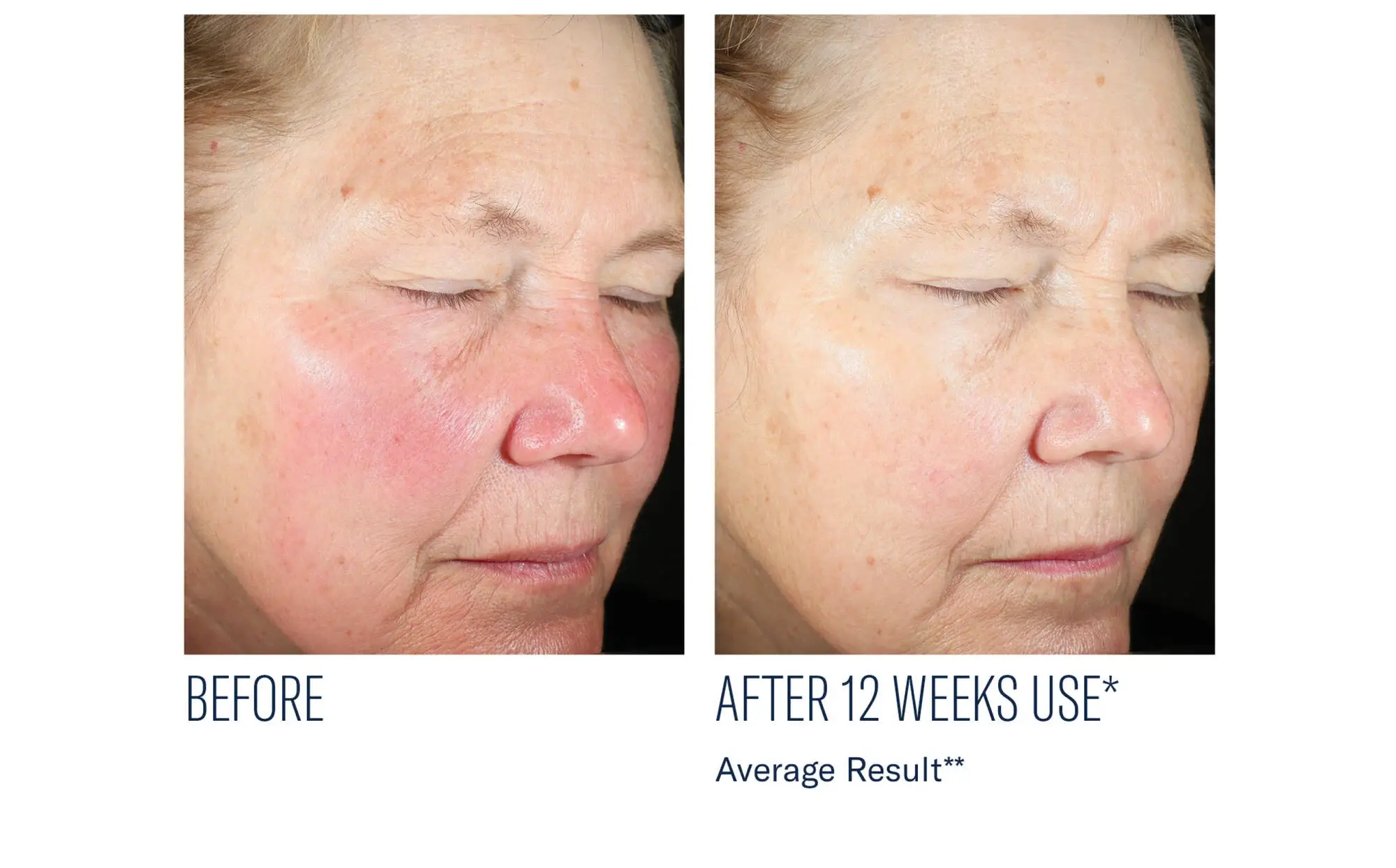 Before and after photos of a skincare protocol, Atelier Med selection.