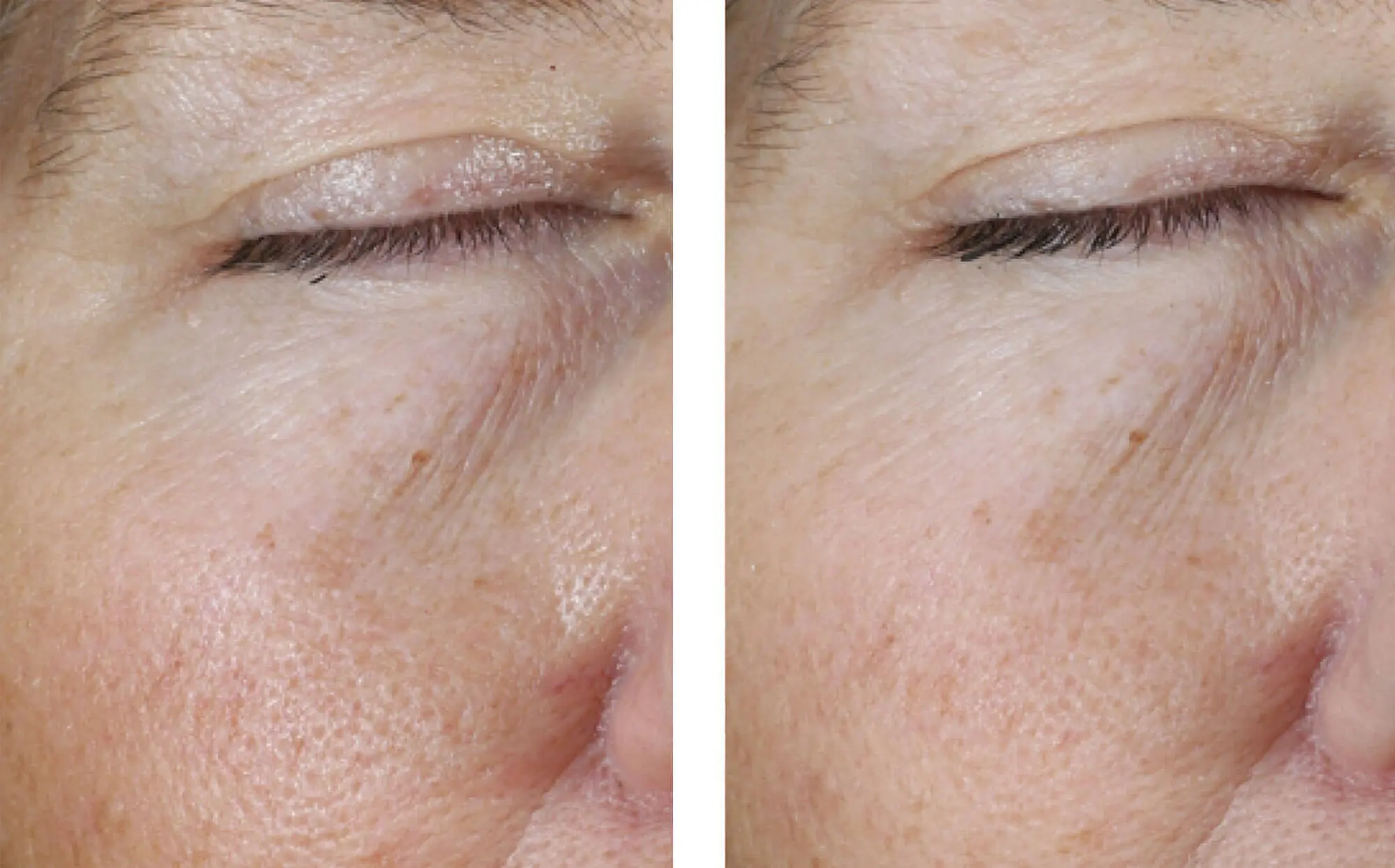 Before and after photos of a skincare protocol, Atelier Med selection.