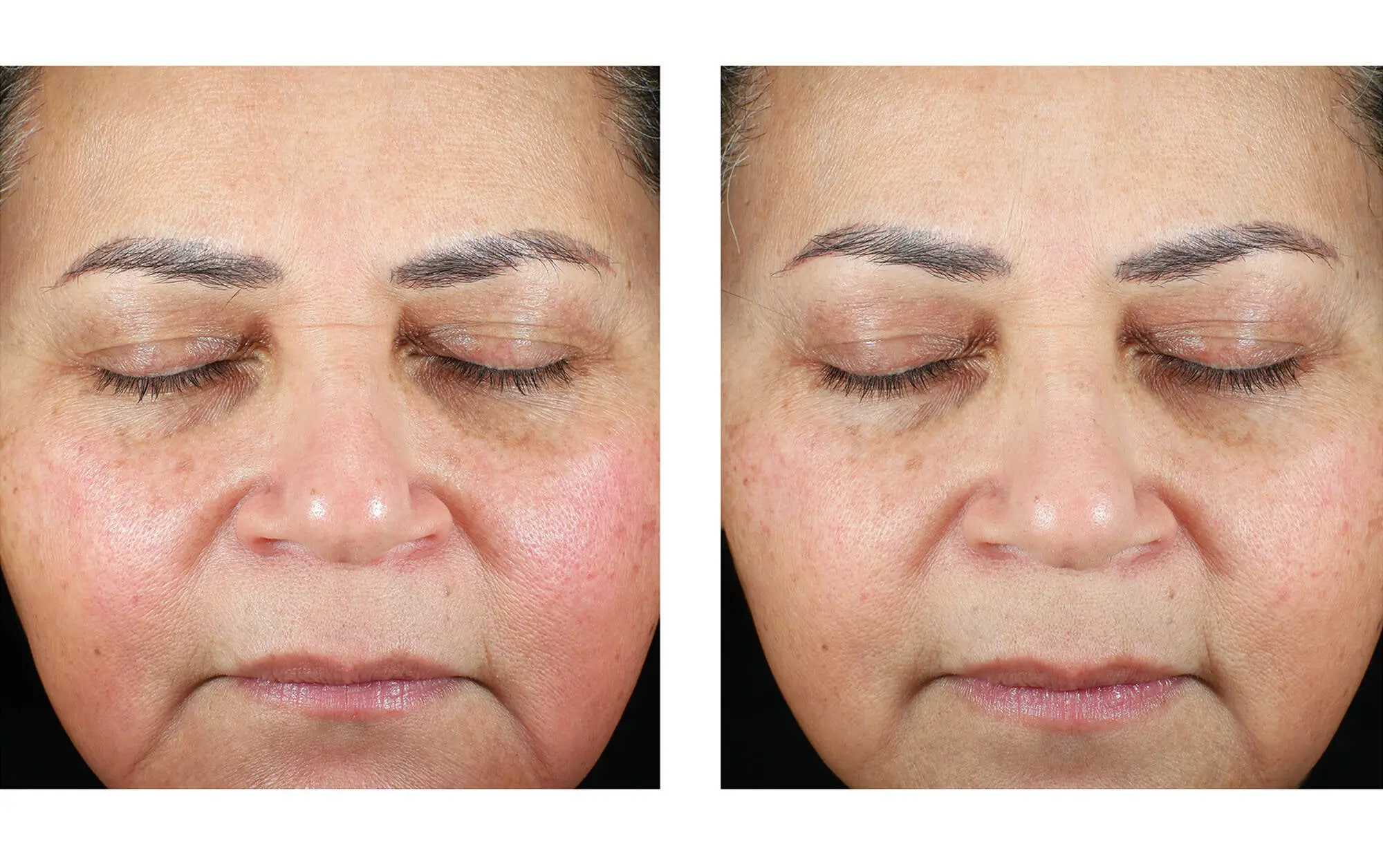 Before and after photos of a skincare protocol, Atelier Med selection.