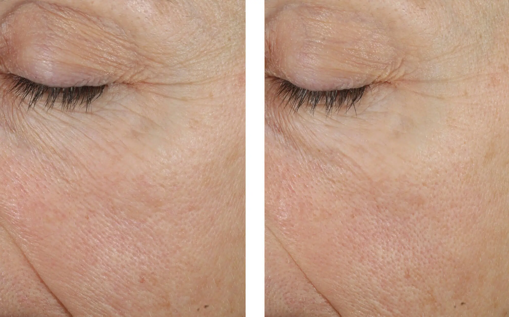 Before and after photos of a skincare protocol, Atelier Med selection.