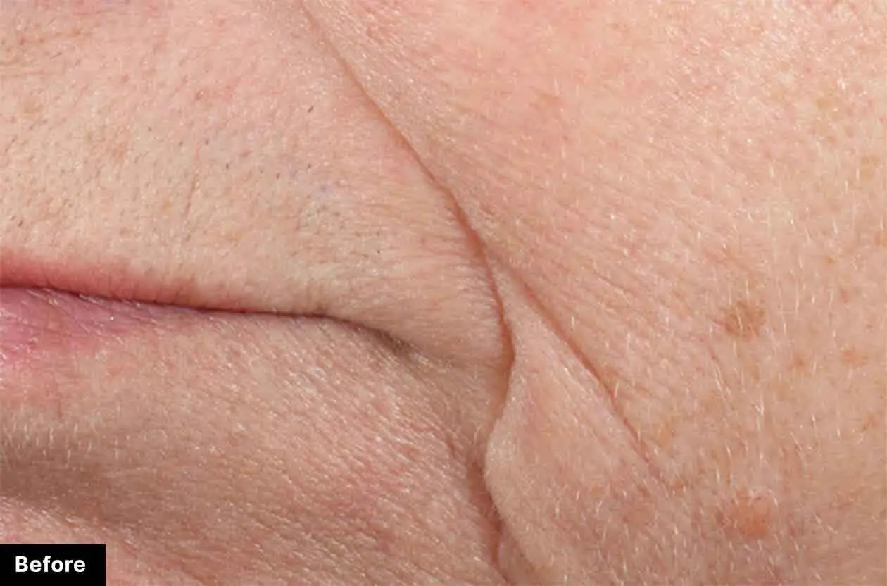 Before : Before and after photos of a skincare protocol, Atelier Med selection.