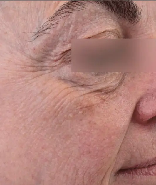 Before : Before and after photos of a skincare protocol, Atelier Med selection.