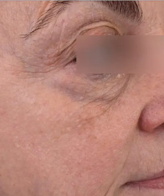 Before and after photos of a skincare protocol, Atelier Med selection.