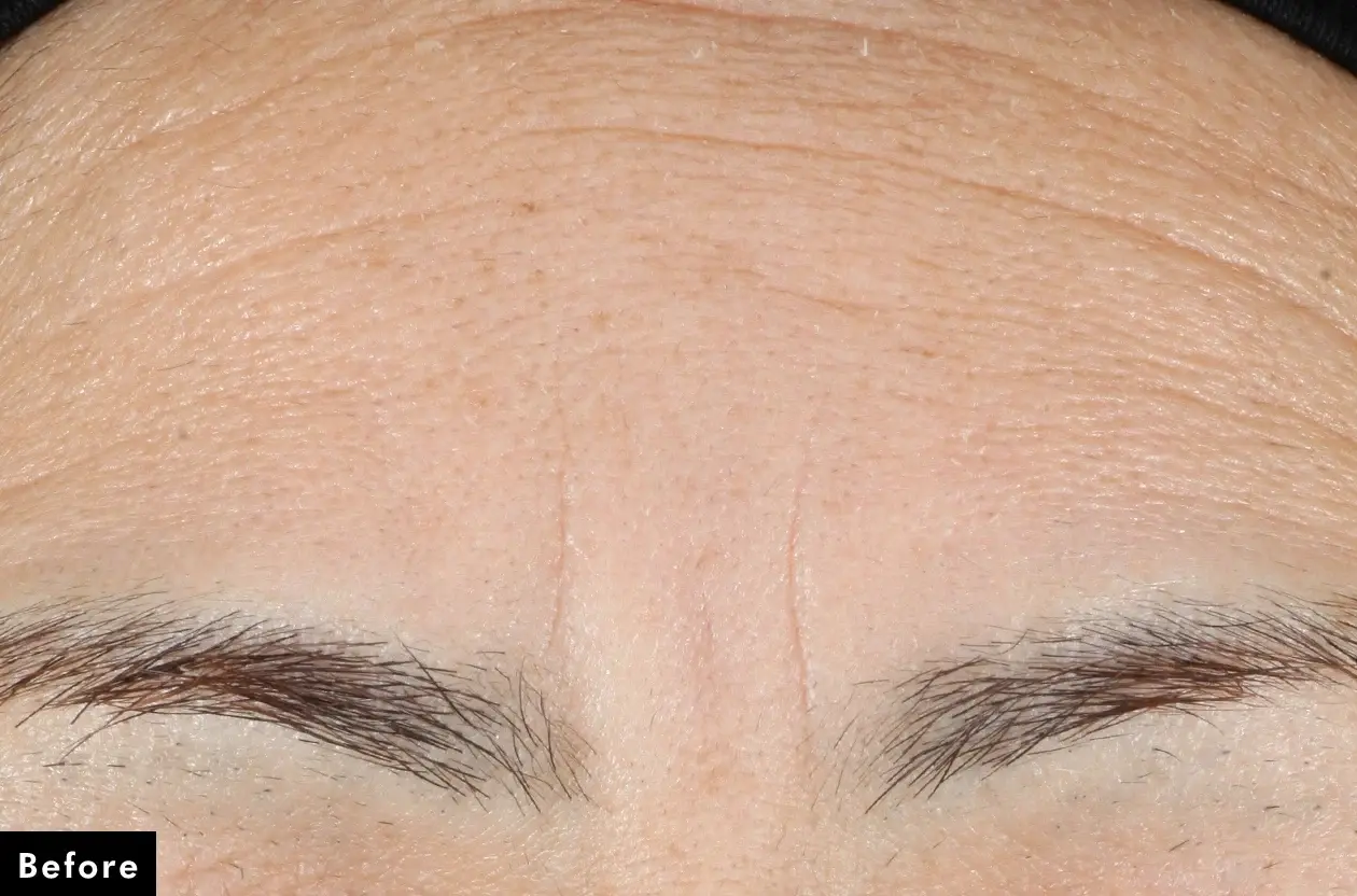 Before : Before and after photos of a skincare protocol, Atelier Med selection.